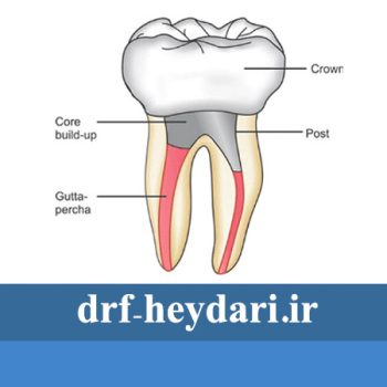 پست کور دندان