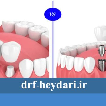 پل دندان بهتر است یا ایمپلنت