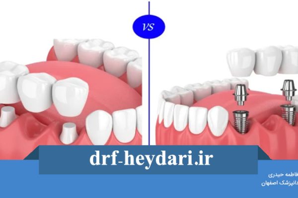 پل دندان بهتر است یا ایمپلنت