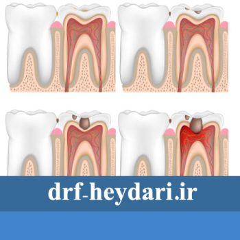 پوسیدگی بین دندانی