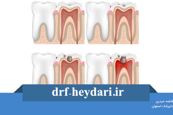 پوسیدگی بین دندانی