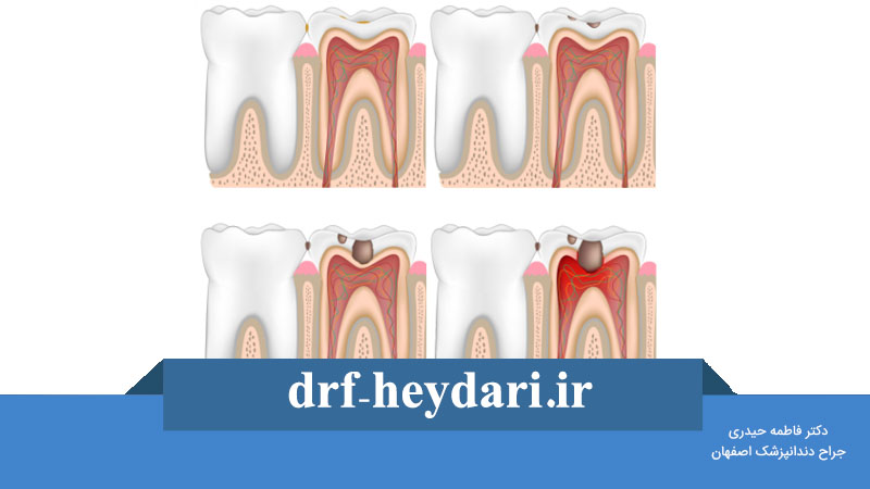 پوسیدگی بین دندانی