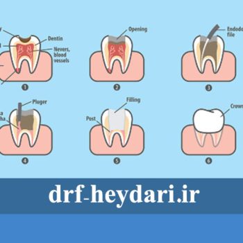 پرکردن و عصب‌کشی دندان