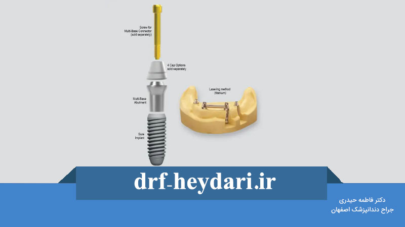 پایه ایمپلنت چیست