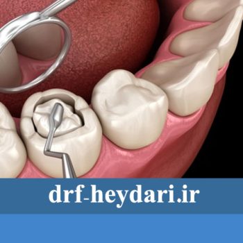 پر کردن دندان با کامپوزیت