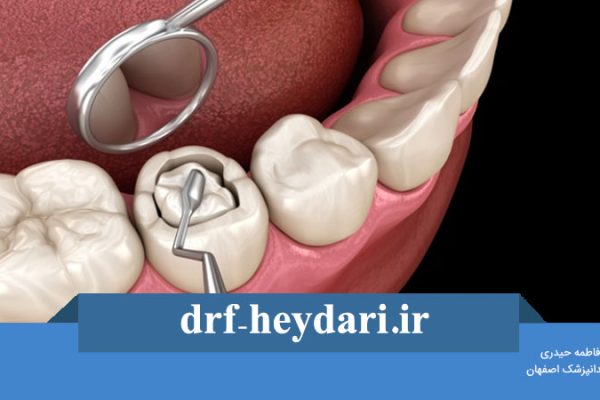 پر کردن دندان با کامپوزیت