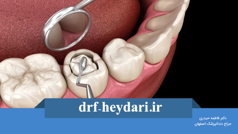 پر کردن دندان با کامپوزیت