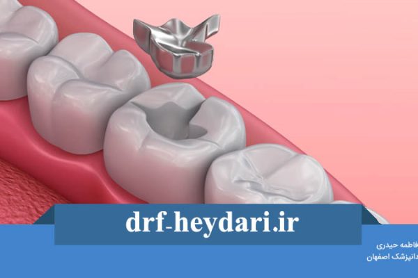 پر کردن دندان با آمالگام