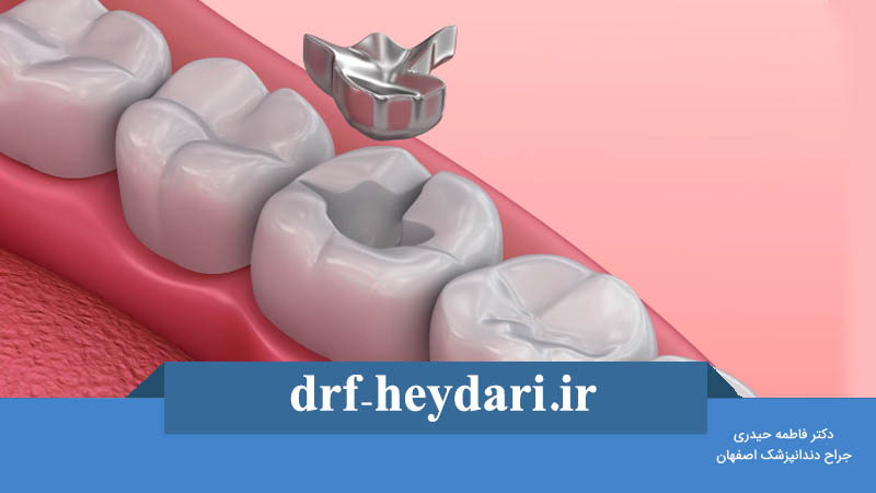 پر کردن دندان با آمالگام