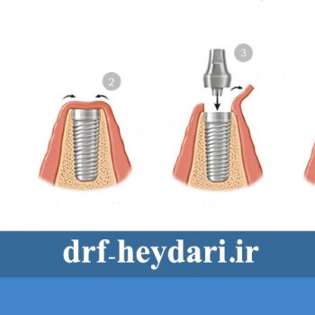 پروسه ایمپلنت دندان