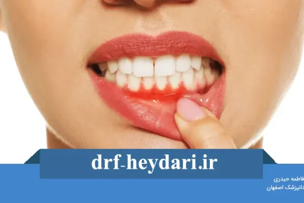 علائم و درمان آبسه دندان