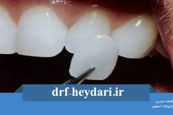 مدت زمان ماندگاری لمینیت دندان