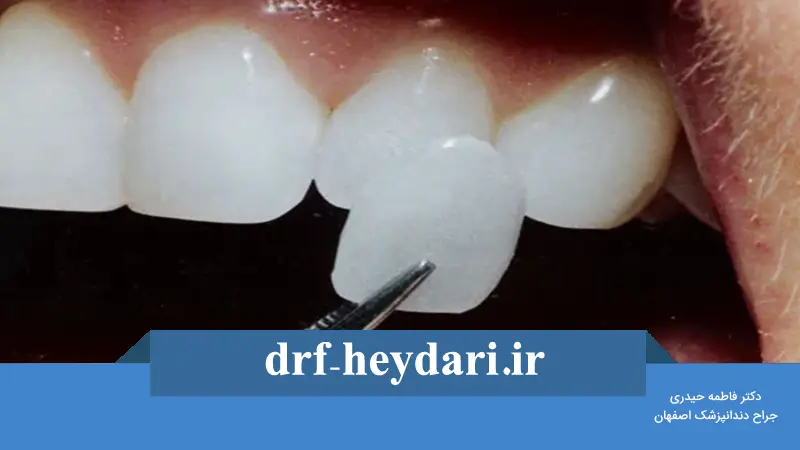 مدت زمان ماندگاری لمینیت دندان
