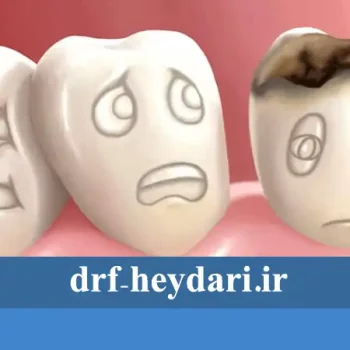 تاثیر دندان پوسیده بر سلامت عمومی بدن