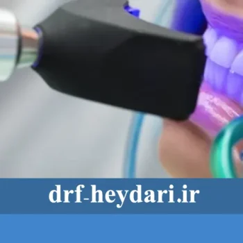 بلیچینگ در خانه یا مطب؟