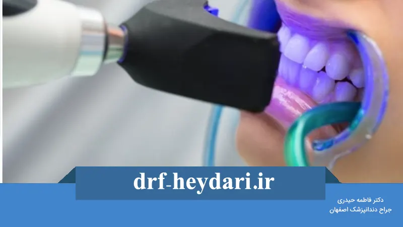 بلیچینگ در خانه یا مطب؟