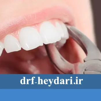 مراقبت‌های بعد از کشیدن دندان