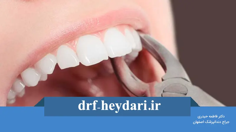 مراقبت‌های بعد از کشیدن دندان