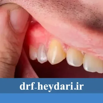 5 بیماری‌ لثه و درمان آن‌