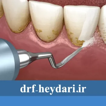 چند وقت یکبار جرم‌گیری دندان لازم است؟
