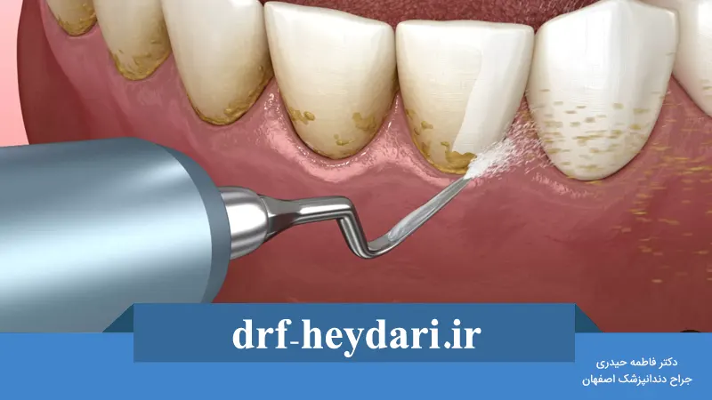 چند وقت یکبار جرم‌گیری دندان لازم است؟