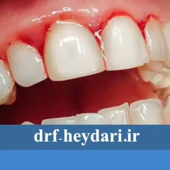 پیشگیری از خونریزی لثه