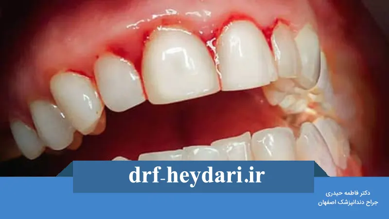 پیشگیری از خونریزی لثه