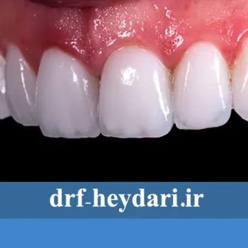 تفاوت بین لمینیت و کامپوزیت دندان