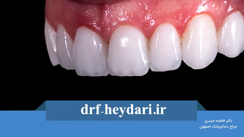 تفاوت بین لمینیت و کامپوزیت دندان