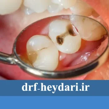 چگونه از پوسیدگی دندان جلوگیری کنیم؟