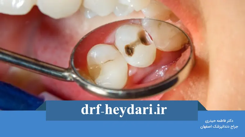 چگونه از پوسیدگی دندان جلوگیری کنیم؟