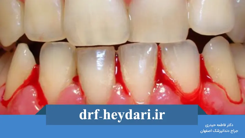 تفاوت بین ژنژیویت و پریودنتیت