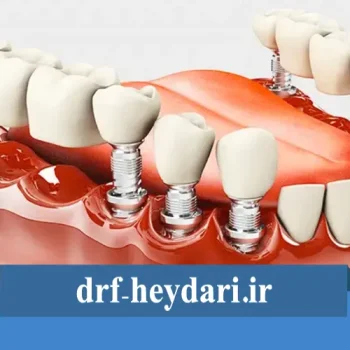 تفاوت پروتز ثابت و متحرک