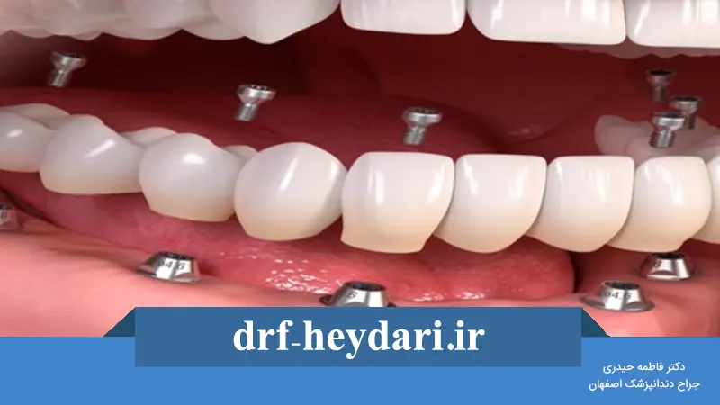 مزایا و معایب ایمپلنت دندانی