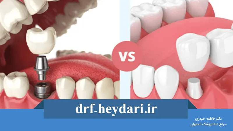 مقایسه بریج و ایمپلنت دندانی