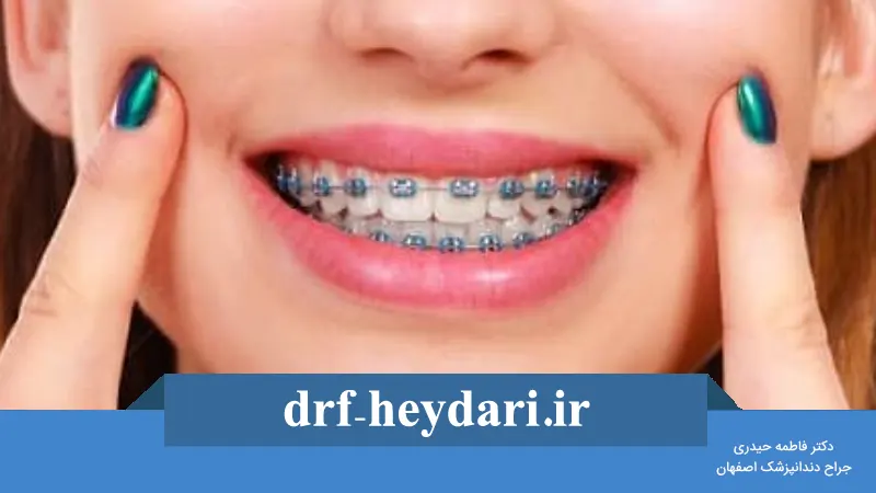 تفاوت بین ارتودنسی ثابت و متحرک