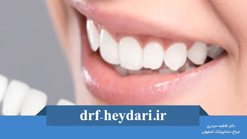 کامپوزیت ونیر چیست؟