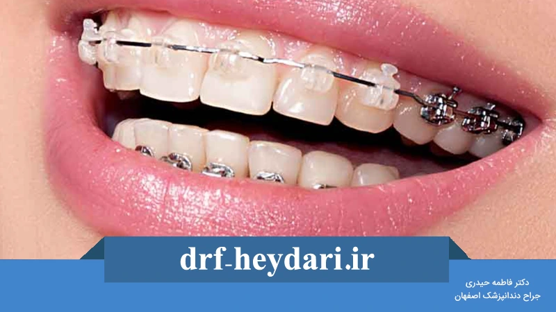 مدت زمان لازم برای درمان ارتودنسی