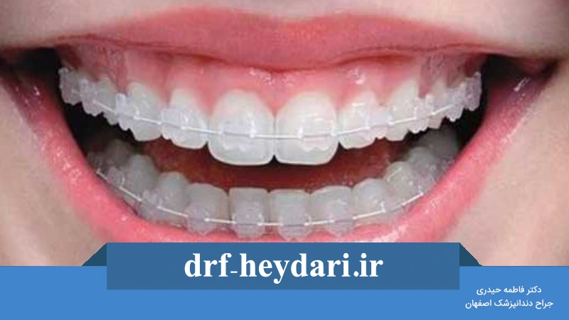 غذا های مناسب در طول ارتودنسی