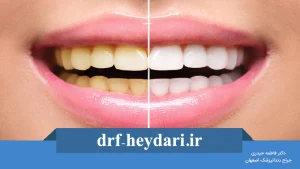 بلیچینگ دندان