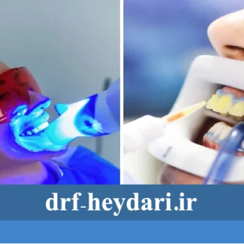 بلیچینگ دندان