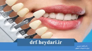 لمینت دندان