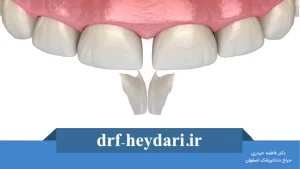 باندینگ دندان