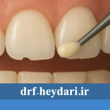 باندینگ دندان