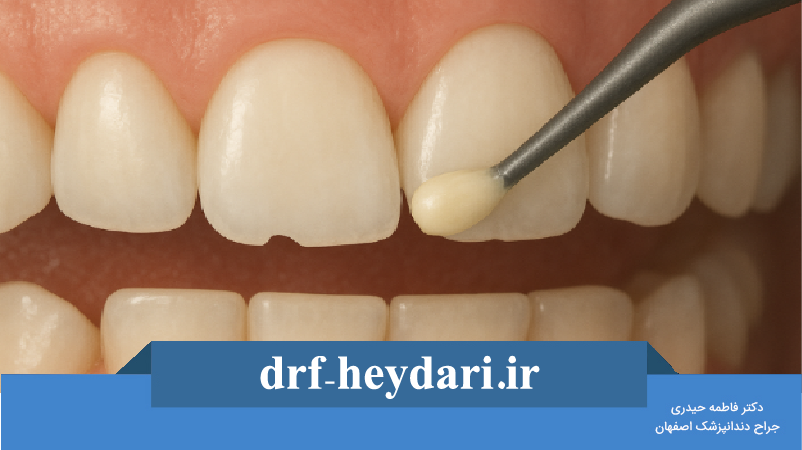 باندینگ دندان