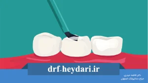 فیشور سیلانت دندان