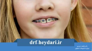 درمان فاصله بین دندانها با ارتودنسی