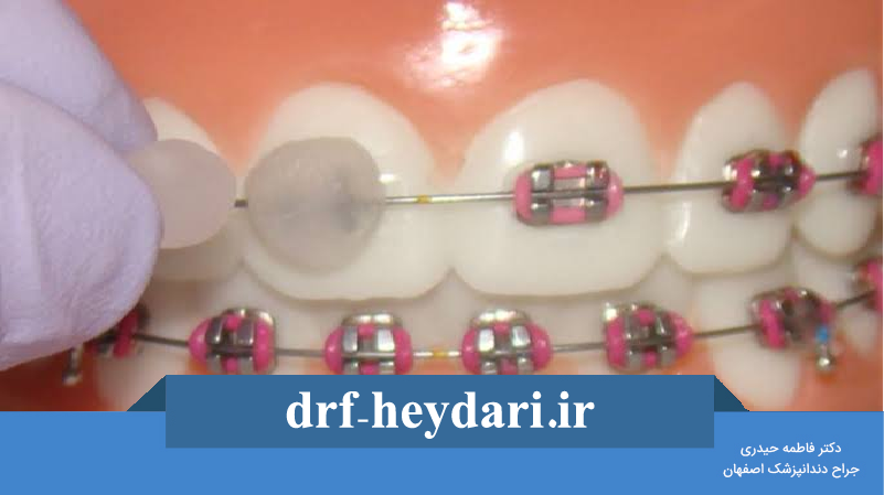 موم ارتودنسی چیست