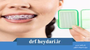 موم ارتودنسی چیست