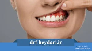 درمان موقتی آبسه دندان در خانه